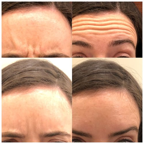 Botox Before and After - IMG 4583