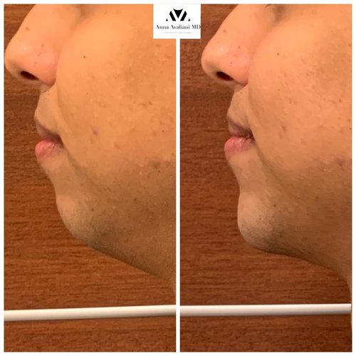 Non Surgical Chin Augmentation Before and After - IMG 5371