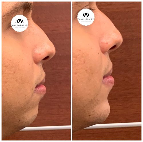 Non Surgical Chin Augmentation Before and After - IMG 5372