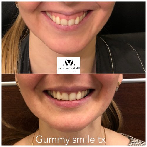 Botox Before and After - IMG 5392