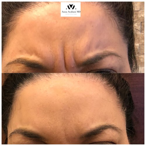 Botox Before and After - IMG 5664