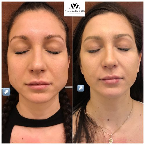 Botox Before and After - IMG 5688