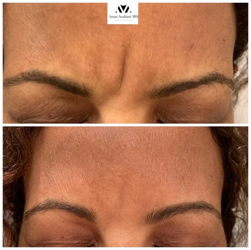 Botox Before and After - IMG 5799
