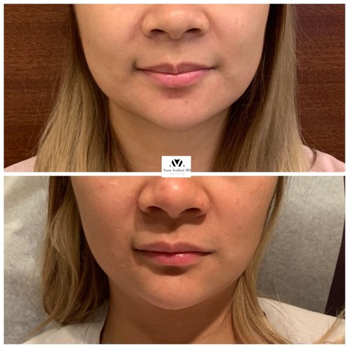 Botox Before and After - IMG 5818