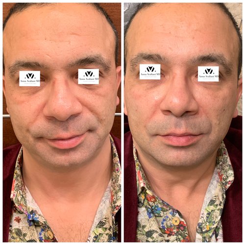 Fillers Before and After - IMG 6051