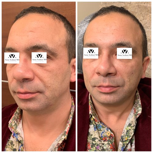 Fillers Before and After - IMG 6052