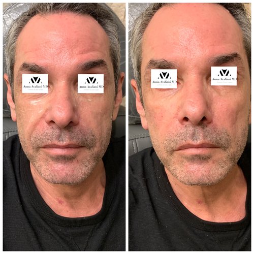 Fillers Before and After - IMG 6053