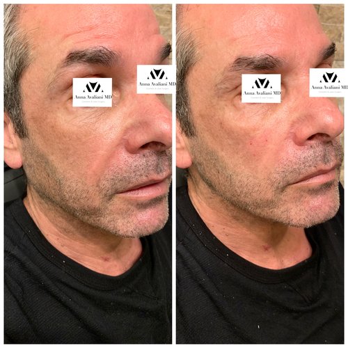 Fillers Before and After - IMG 6054