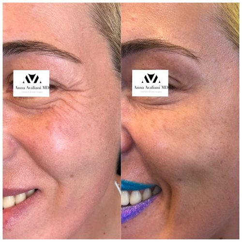 Botox Before and After - IMG 6084