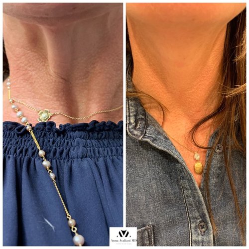 Botox Before and After - IMG 6182