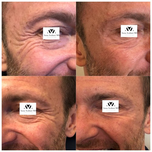 Botox Before and After - IMG 6379