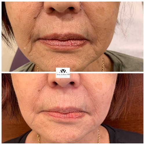 Fillers Before and After - IMG 6524