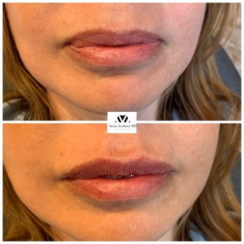 Lip Augmentation Before and After - IMG 6660