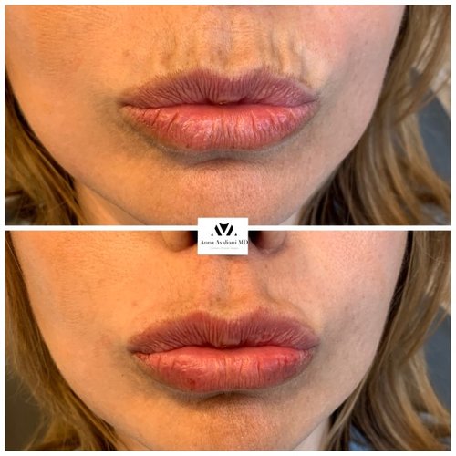 Lip Augmentation Before and After - IMG 6661