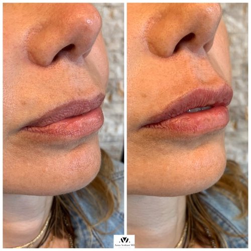 Lip Augmentation Before and After - IMG 6662