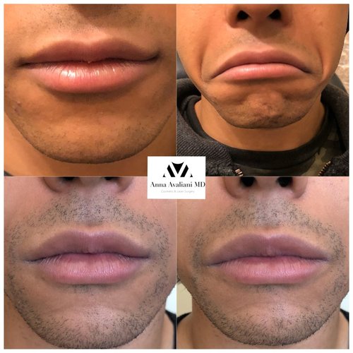 Botox Before and After - IMG 6836