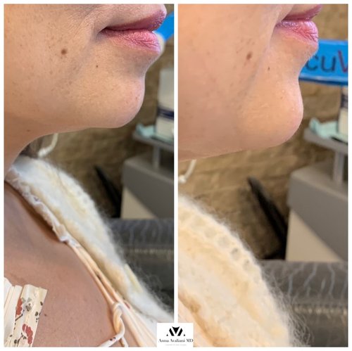 Non Surgical Chin Augmentation Before and After - IMG 6895