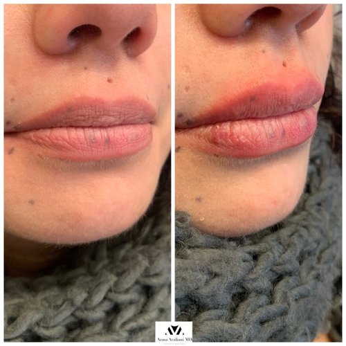 Lip Augmentation Before and After - IMG 6896