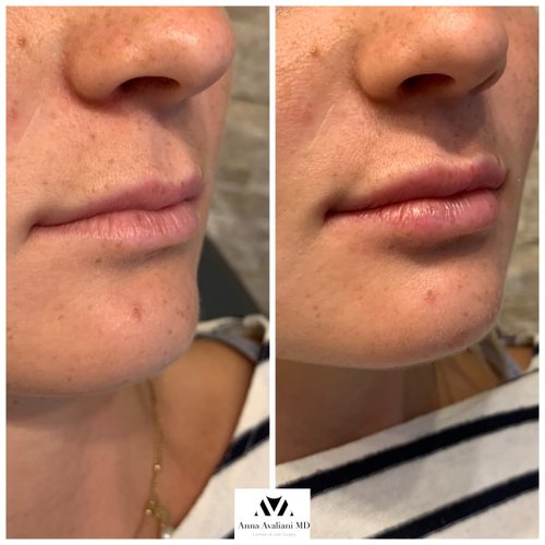 Lip Augmentation Before and After - IMG 6901