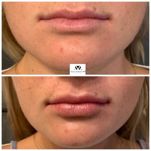 Lip Augmentation Before and After - IMG 6902