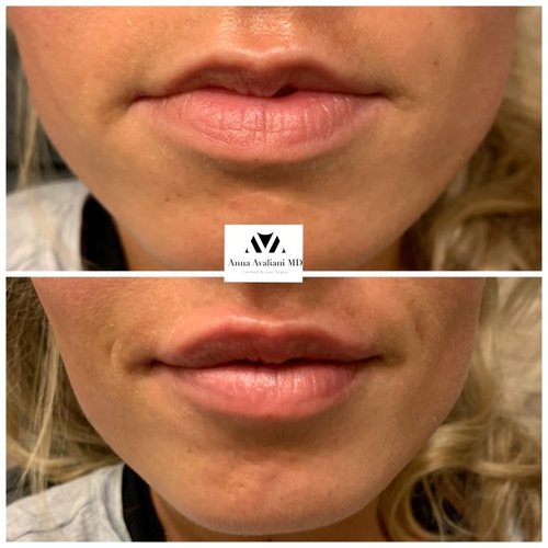 Lip Augmentation Before and After - IMG 6996