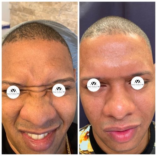 Botox Before and After - IMG 6997