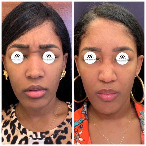 Botox Before and After - IMG 6998