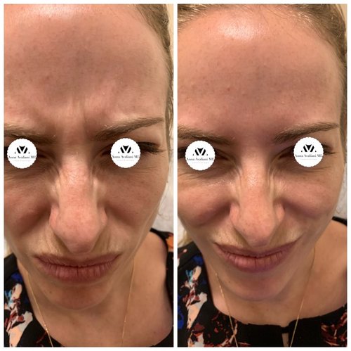Botox Before and After - IMG 6999