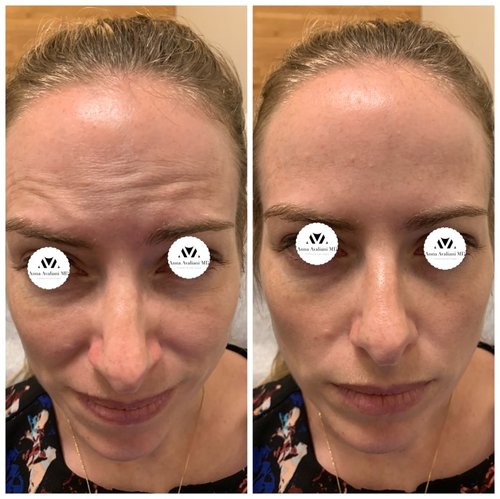 Botox Before and After - IMG 7001