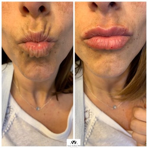 Lip Augmentation Before and After - IMG 7007