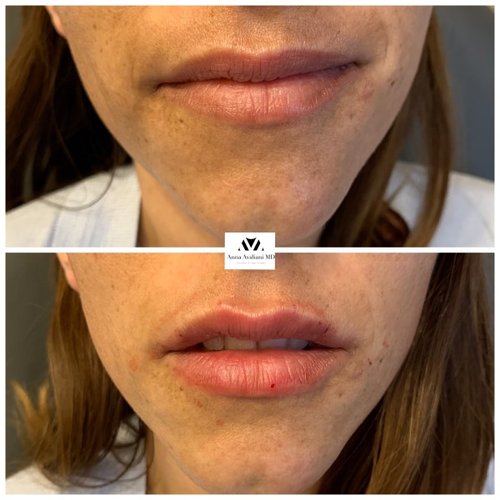 Lip Augmentation Before and After - IMG 7008