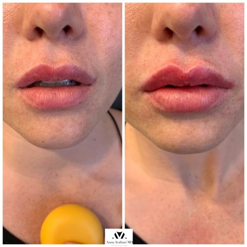 Lip Augmentation Before and After - IMG 7009