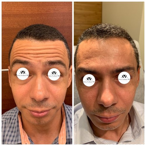 Botox Before and After - IMG 7010