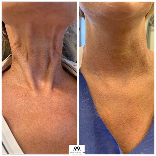 Botox Before and After - IMG 7016