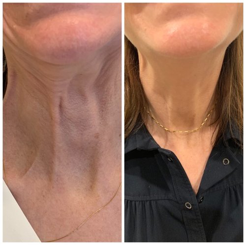 Botox Before and After - IMG 7047