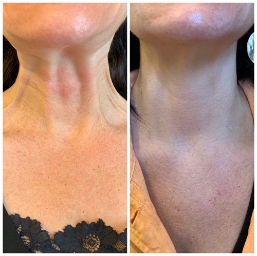 Botox Before and After - IMG 7149