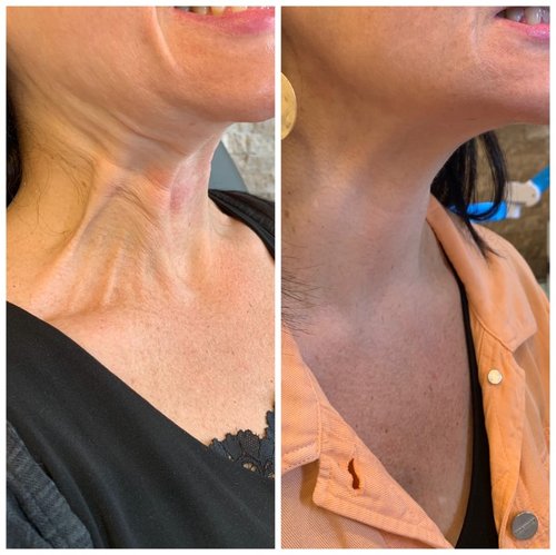 Botox Before and After - IMG 7150