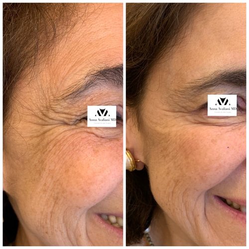 Botox Before and After - IMG 7249