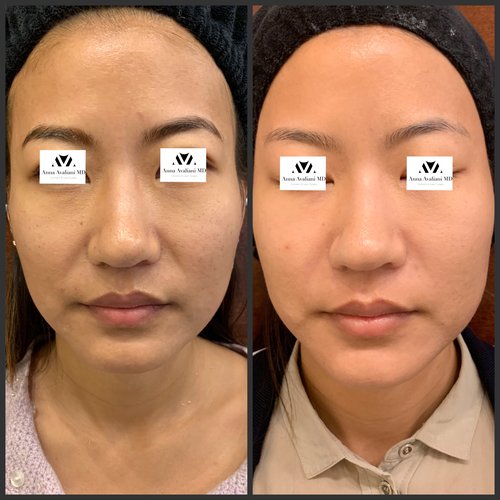Picosure / Laser Skin Rejuvenation Before and After - IMG 7303