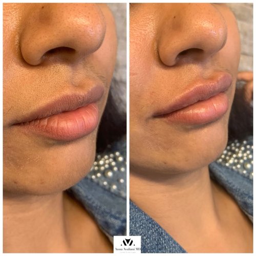 Lip Augmentation Before and After - IMG 7463
