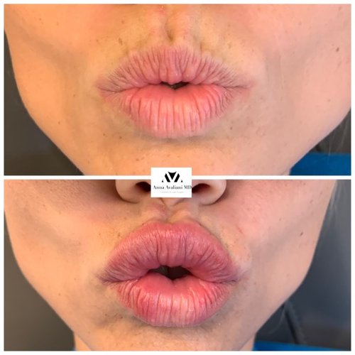 Lip Augmentation Before and After - IMG 7617