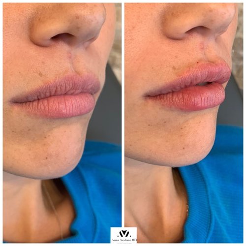 Lip Augmentation Before and After - IMG 7618