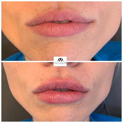 Lip Augmentation Before and After - IMG 7619