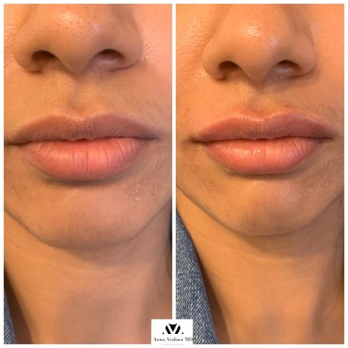 Lip Augmentation Before and After - IMG 7620