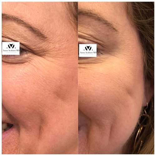 Botox Before and After - IMG 7960