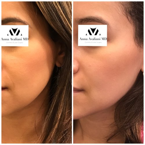 Fillers Before and After - IMG 8383