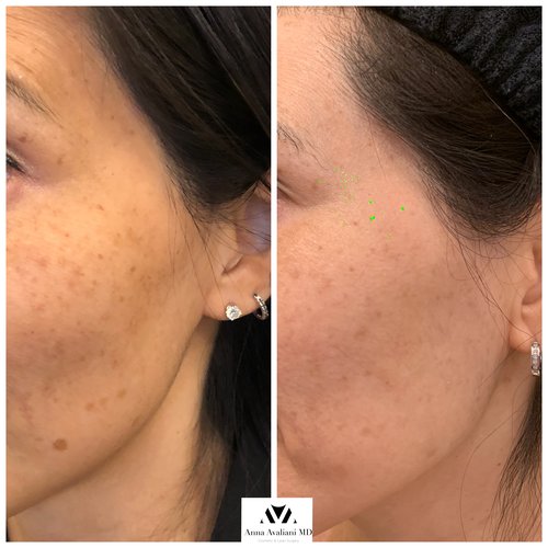 Picosure / Laser Skin Rejuvenation Before and After - IMG 8509