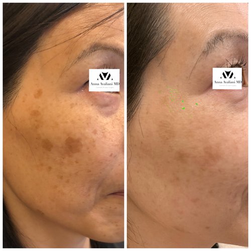 Picosure / Laser Skin Rejuvenation Before and After - IMG 8510