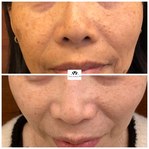 Picosure / Laser Skin Rejuvenation Before and After - IMG 8511