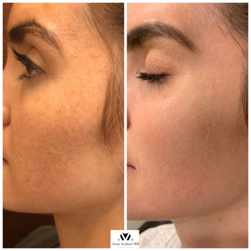 Picosure / Laser Skin Rejuvenation Before and After - IMG 8512